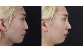 코수술(매부리,휜코,콧볼축소 / 콧대-실리콘, 코끝-비중격,귀연골) 수술 후 2주