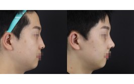 무보형물 코수술(매부리코,절골 / 콧대-X, 코끝-비중격,귀연골) 1개월차