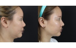 코재수술(휜코,연장 / 콧대-실리콘, 코끝-비중격,귀연골) 수술 후 1개월
