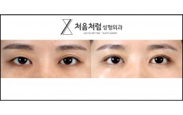 눈밑지방재배치 / 수술 후 2개월