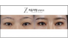 처음처럼 눈수술  절개눈매교정, 트임(앞,뒤,밑) 2개월