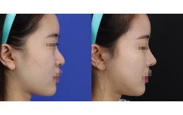 코수술(긴코교정 / 콧대-실리콘, 코끝-비중격,귀연골) 수술 후 3개월