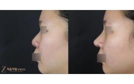 코수술(복코 / 콧대-실리콘, 코끝-비중격,기증늑,귀연골) 수술 후 1개월