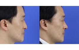 무보형물 코수술(긴코 / 콧대-X, 코끝-귀연골) 수술 후 2주