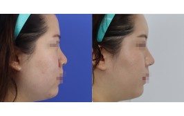 코수술(코끝연장,콧볼축소 / 콧대-실리콘, 코끝-비중격,귀연골) 수술 후 2개월
