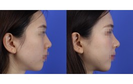 무보형물 코수술(매부리,절골,단차개선 / 콧대-X, 코끝-비중격,귀연골) 수술 후 3개월