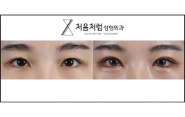 절개눈매교정 / 앞트임 / 밑트임 / 수술 후 3개월