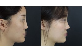 코재수술(비주연장,휜코교정 / 콧대-실리콘, 코끝-자가늑,기존연골) 3개월차