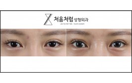 눈재수술 / 절개눈매교정 / 수술 후 1개월
