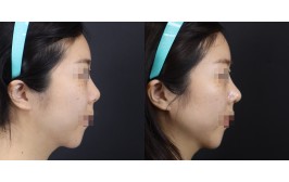 무보형물 코수술(연장 / 콧대-X, 코끝-비중격,귀연골) 수술 후 1개월
