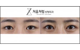 눈 재수술(절개눈매교정), 앞트임 3개월