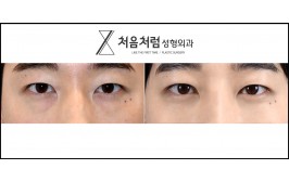 눈밑지방재배치 / 수술 후 3개월