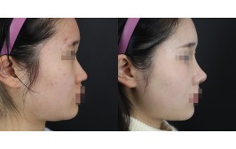 코수술(콧대-실리콘, 코끝-비중격,자가늑) 1개월차