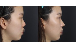 무보형물 코수술(연장,콧볼축소 / 콧대-X, 코끝-비중격,귀연골) 수술 후 1개월