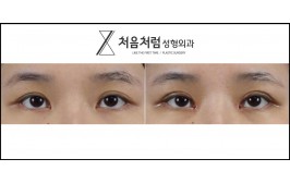 눈재수술(절개) 앞트임 1개월