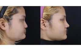 코수술(휜코 / 콧대-실리콘, 코끝-비중격,귀연골) 1개월차