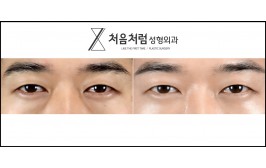 눈밑지방재배치 / 수술 후 1개월
