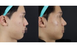 무보형물 코수술(연장,비주연장,콧볼축소 / 콧대-X, 코끝-비중격,귀연골) 1개월차