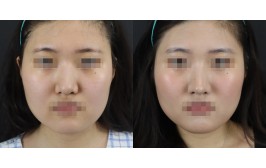 무보형물 코재수술(비주교정 / 콧대-X, 코끝-자가늑,기존연골) 수술 후 2개월