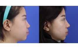 코수술(매부리,휜코,콧등단차 / 콧대-실리콘, 코끝-비중격,귀연골) 수술 후 1개월