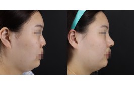 코재수술(연장 / 콧대-실리콘, 코끝-기증늑,귀연골) 1개월차