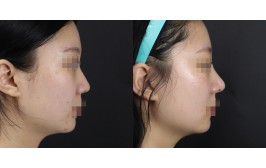 코수술(콧대-실리콘, 코끝-비중격,귀연골) 수술 후 1개월