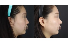 무보형물 코수술(연장,비주연장,절골 / 콧대-X, 코끝-자가늑,기증근막) 1개월차
