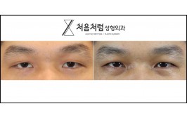 상안검 눈매교정 5개월