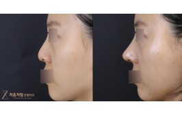 무보형물 코수술(절골,비공내리기 / 콧대-X, 코끝-비중격,귀연골) 수술 후 1개월