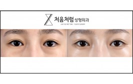 눈밑지방재배치 / 수술 후 1개월