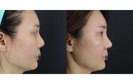 코재수술(연장 / 콧대-실리콘, 코끝-비중격,귀연골) 수술 후 3개월