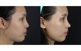 코재수술(콧대-실리콘, 코끝-비중격,귀연골) 수술 후 1개월