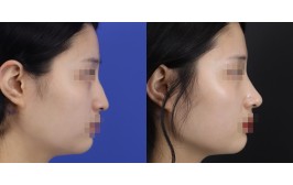 무보형물 코수술(매부리,긴코교정 / 콧대-X 코끝-비중격,귀연골) 수술 후 1개월