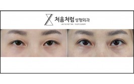 상안검 눈매교정, 밑트임재수술 5개월