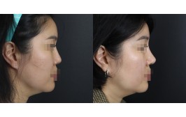 코수술(콧대-실리콘, 코끝-비중격) 1개월차