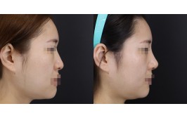 코수술(콧대-실리콘, 코끝-비중격,귀연골) 수술 후 3주