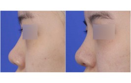 코수술 (콧대-실리콘, 코끝-귀연골), 콧볼축소 3개월