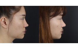 코재수술(휜코교정,실리콘내리기 / 콧대-실리콘, 코끝-기존연골,엉덩이진피) 3개월