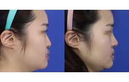 코수술(코끝연장,휜코,비주교정 / 콧대-실리콘, 코끝-비중격,귀연골) 수술 후 1개월