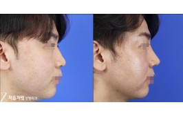 코수술(휜코교정,매부리,콧볼축소 / 콧대-실리콘, 코끝-비중격,귀연골) 수술 후 1개월