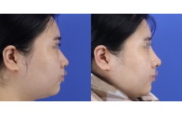 코수술(코끝연장,휜코교정 / 콧대-실리콘, 코끝-비중격) 수술 후 1개월