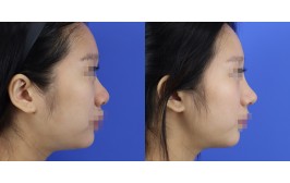 코수술(코끝연장,복코교정 / 콧대-실리콘.  코끝-비중격,귀연골) 수술 후 1개월
