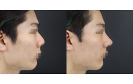 무보형물 코수술(매부리,연장,콧볼축소 / 콧대-실리콘, 코끝-비중격) 수술 후 3개월