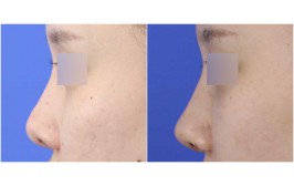 코재수술(찝힌코/ 콧대-실리콘, 코끝-비중격,귀연골) 3개월