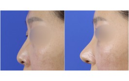 무보형물 코수술(코끝연장, 비공내리기  콧대- X, 코끝-귀연골) 수술후1개월