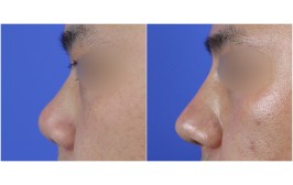 코수술(코끝연장,  콧대-실리콘, 코끝-비중격,귀연골) 수술후3개월