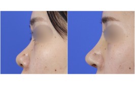 코수술(코끝연장  콧대- 실리콘, 코끝-비중격,귀연골) 수술후2주