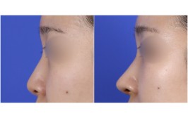 무보형물 코수술(코끝연장  콧대-X , 코끝-비중격,귀연골) 수술후 2주