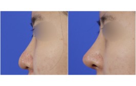 코수술(콧대- 실리콘, 코끝-비중격,귀연골) 수술후1개월