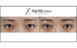 매몰눈매교정 / 앞트임 / 수술 후 1개월